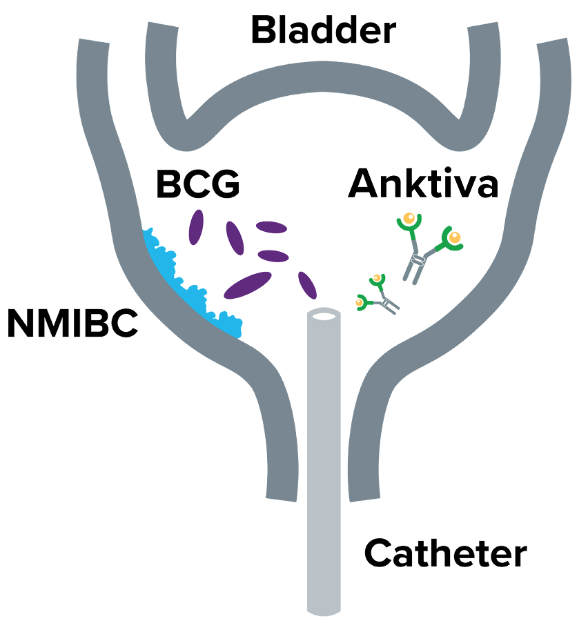Diagram illustrating intravesical instillation for non-muscle invasive bladder cancer (NMIBC): a simplified cross-section of the bladder and urethra with a catheter inserted, showing BCG bacteria (purple ovals) coating the bladder wall and ANKTIVA molecules (green Y-shaped structures with orange spheres) binding nearby, labeled with "Bladder", "Catheter", "BCG", "Anktiva", and "NMIBCBC"